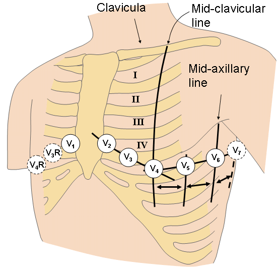 right-ventricular-myocardial-infarction-foamcast