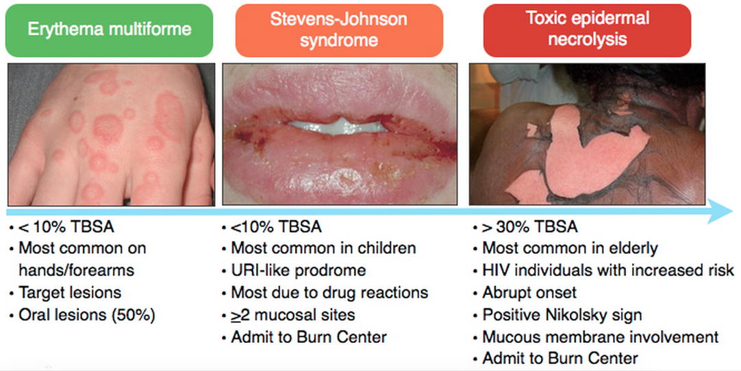 stevens-johnson-syndrome-and-toxic-epidermal-necrolysis-flashcards-my