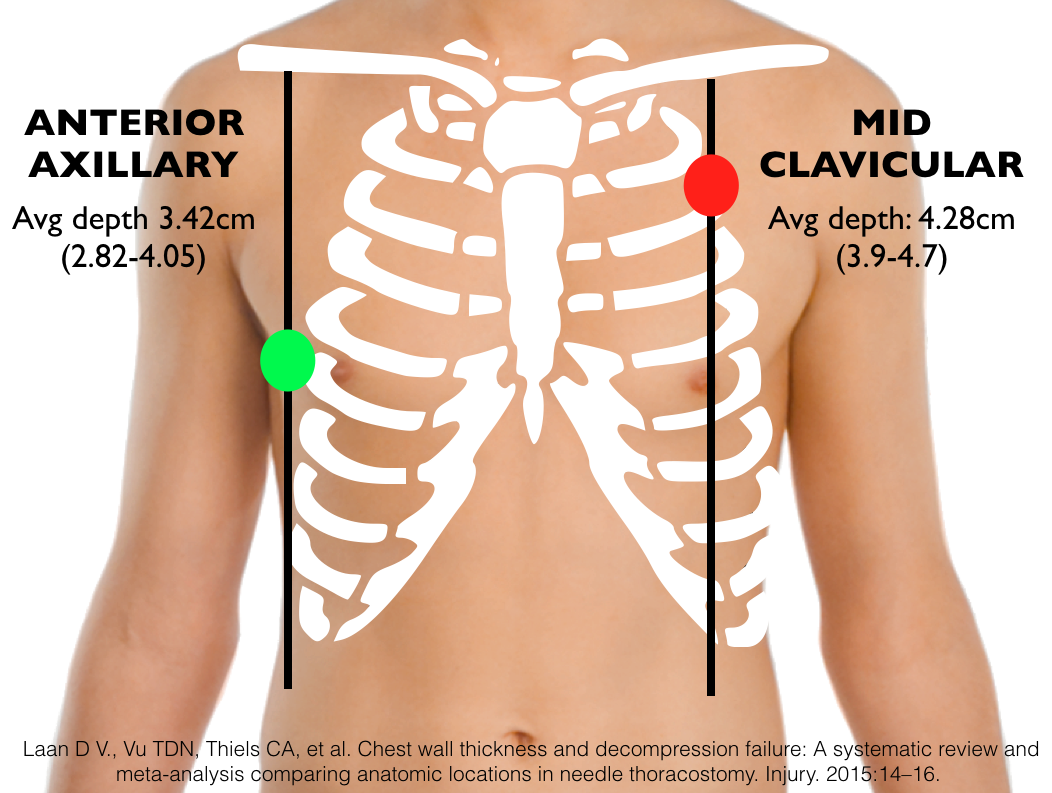 Cracked Rib Or Punctured Lung During Shoulder