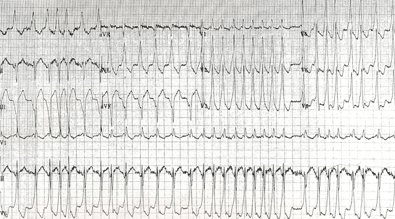 atrial fibrillation and atrial flutter icd 10