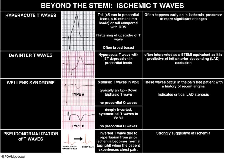 episode-68-ischemic-electrocardiograms-foamcast